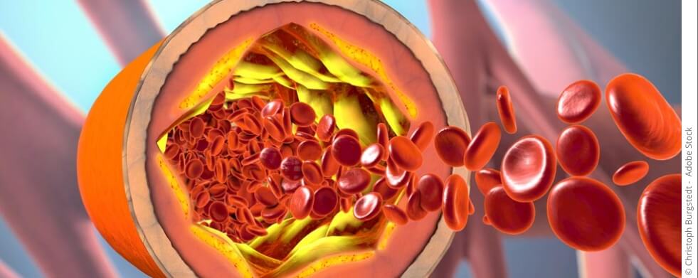 bildliche Querschnittsdarstellung einer Ader mit Blutblättchen